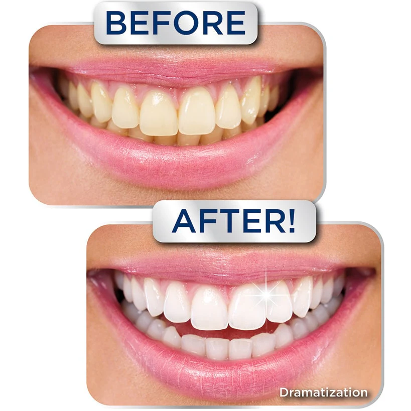 Miracle Smile® Teeth Whitening Gel - 2 Shades Whiter in 2 Minutes - Image 2